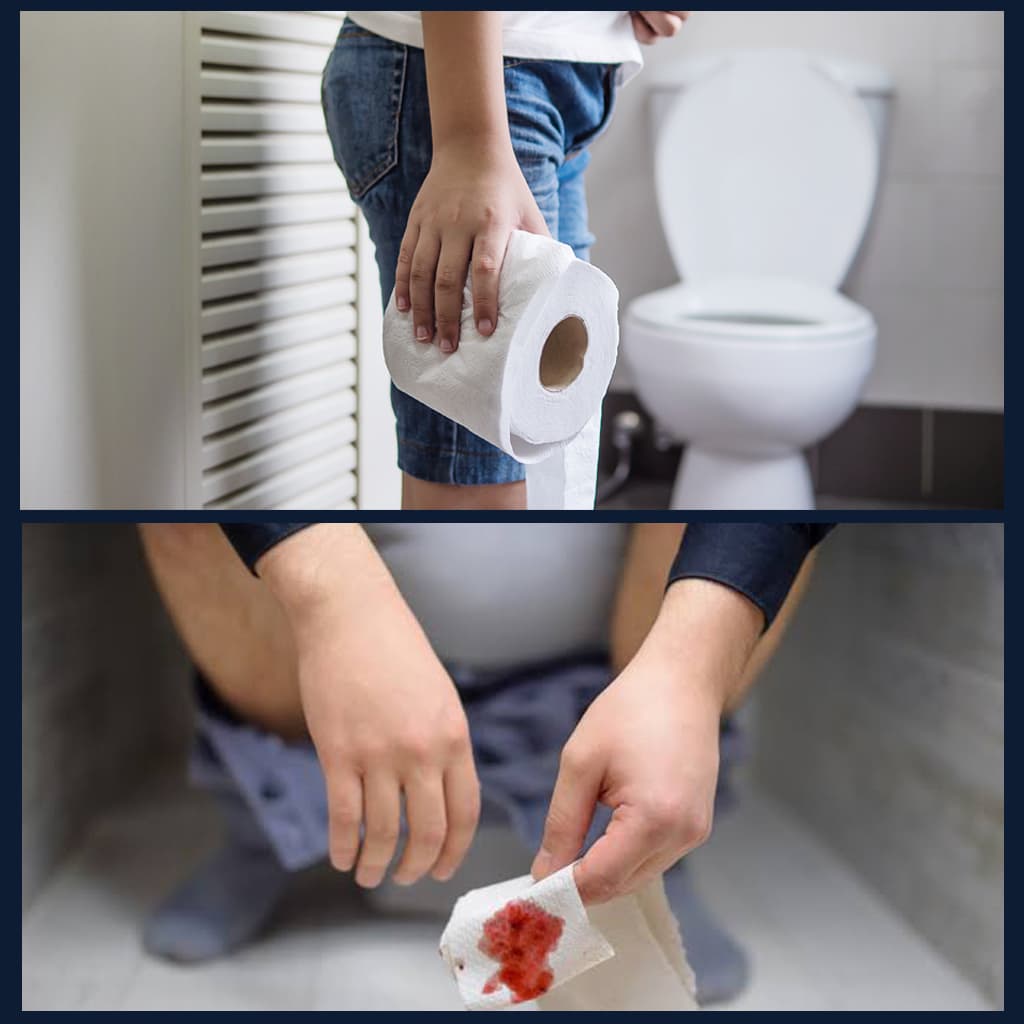 Hemorrhoids and anorectal health illustration